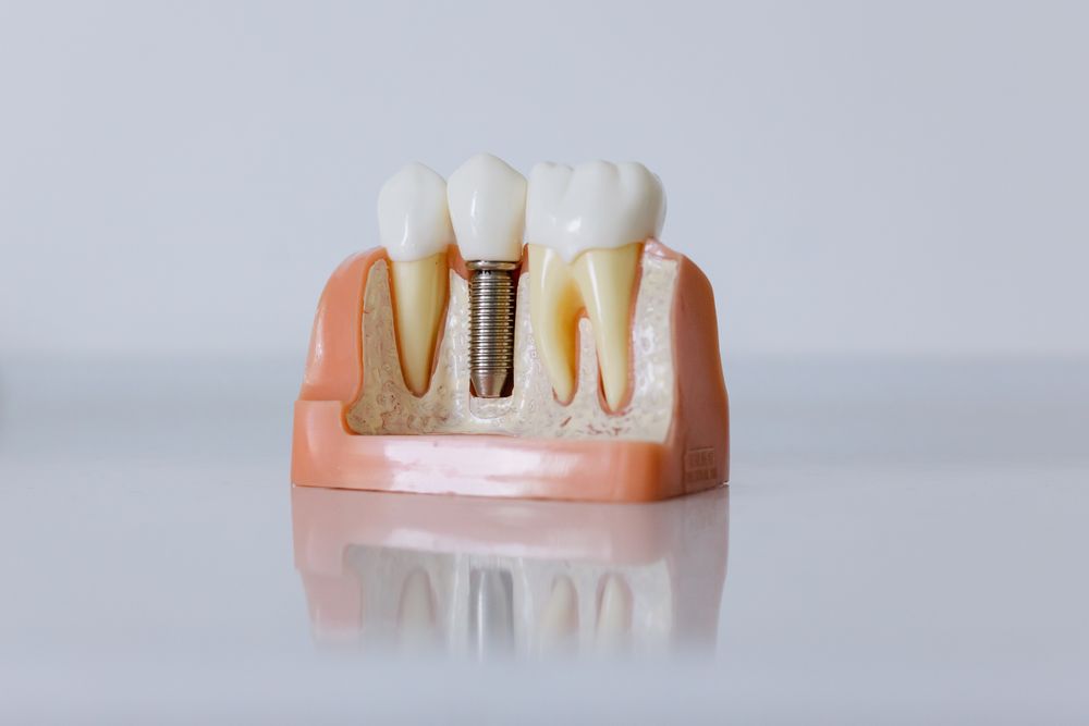 Dental implants
